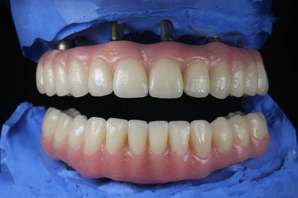 Why You Should Choose Implant Supported Dentures